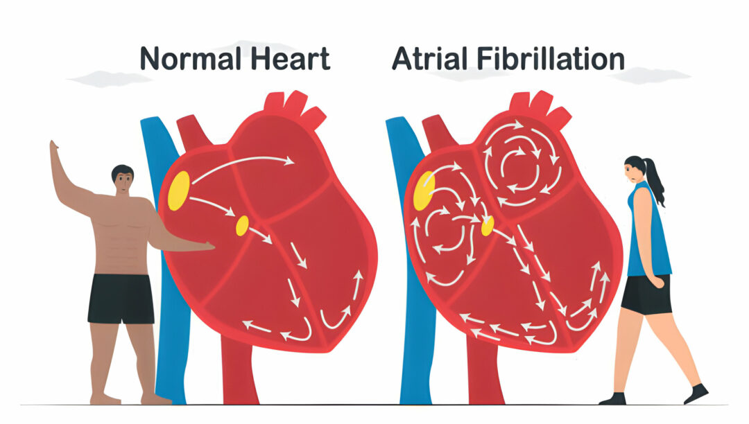 Understanding the Different Types of Atrial Fibrillation Medications