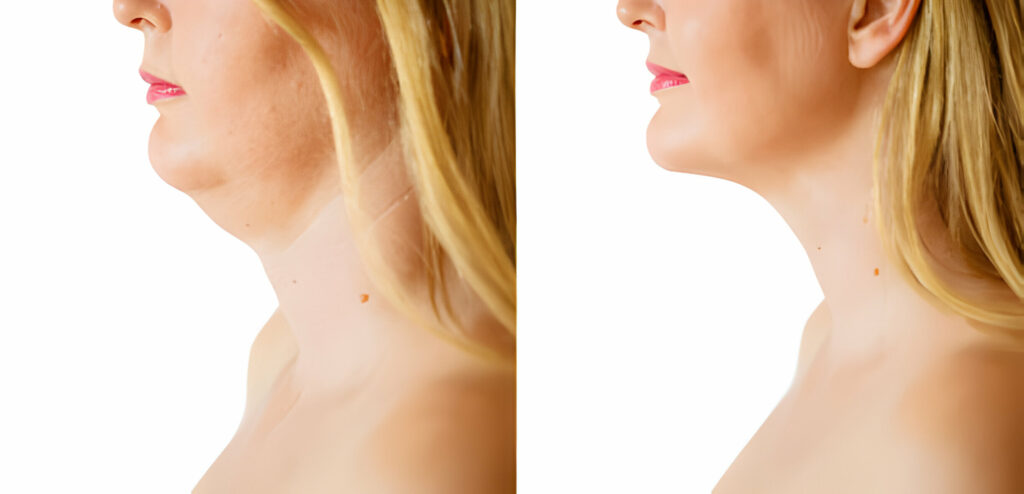 Tighten Neck Skin