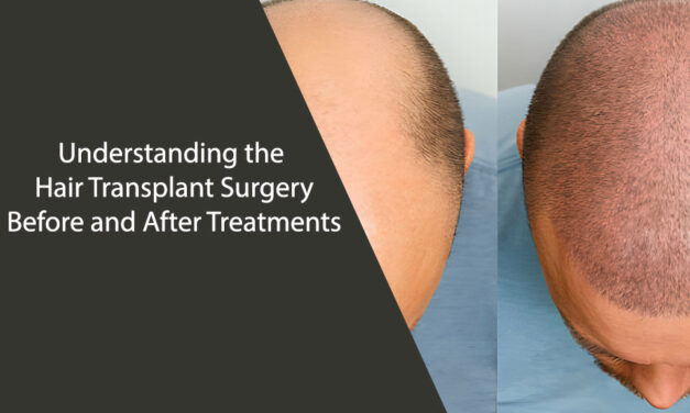 Understanding the Hair Transplant Surgery Before and After Treatments