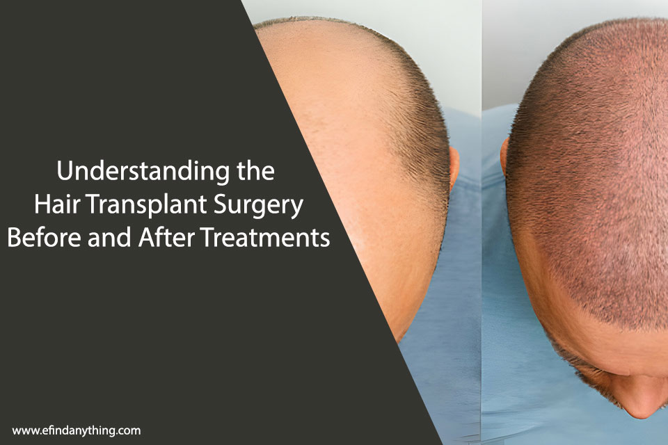 Understanding the Hair Transplant Surgery Before and After Treatments