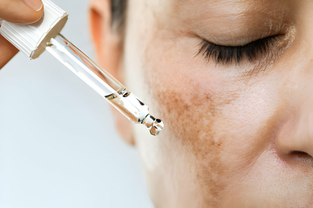 Chemical Peel for Hyperpigmentation